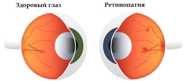 Ретинопатии сетчатки глаза (стадии) Ретинопатии сетчатки глаза - стадии
